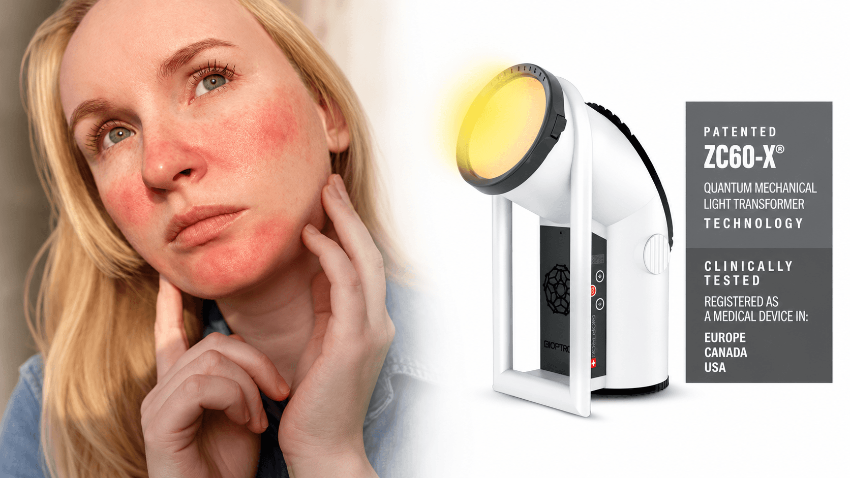 HIPERSVETLOSNA TERAPIJA U TRETMANU ATOPIJSKOG DERMATITISA