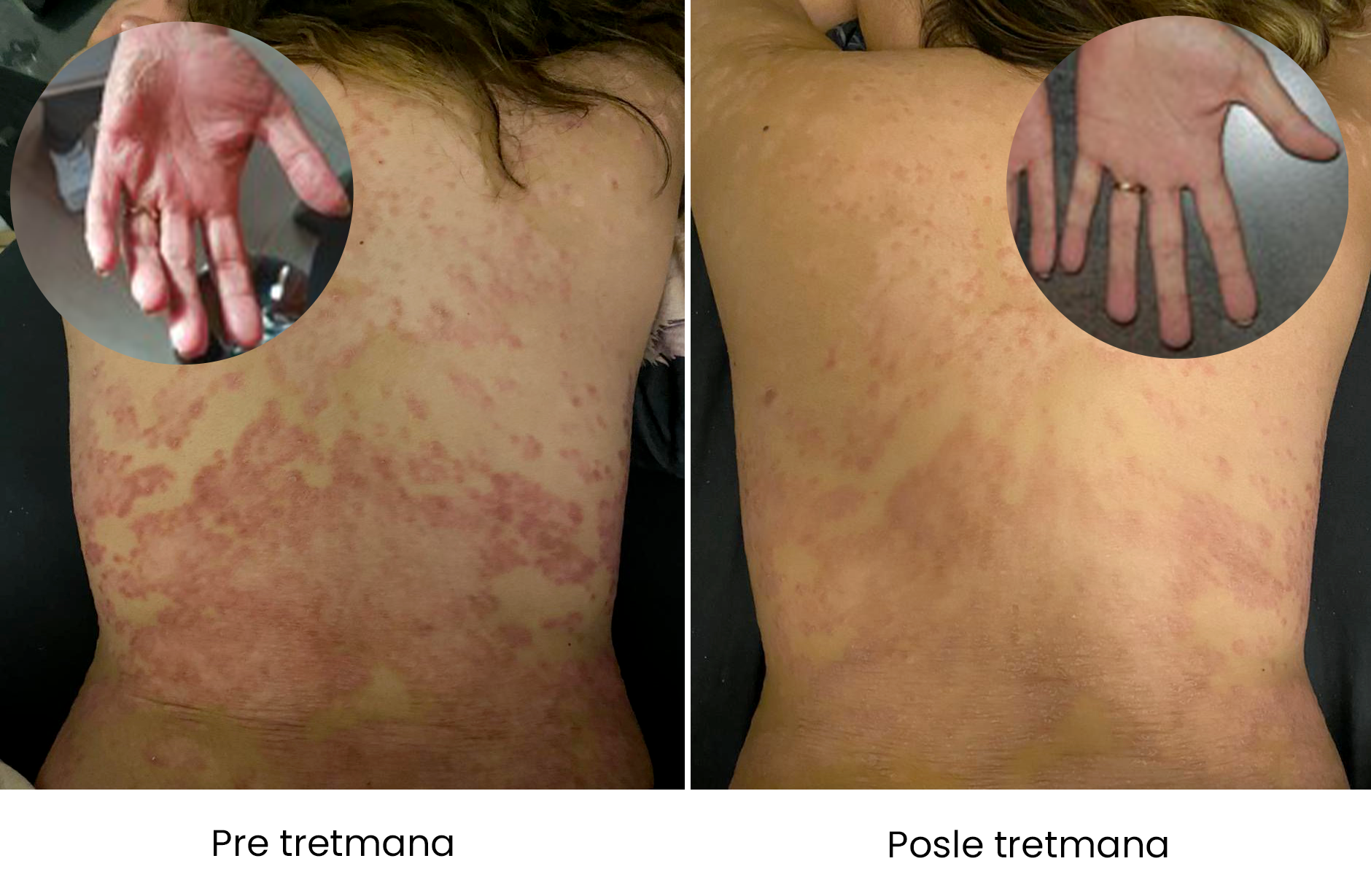 Psoriasis.png